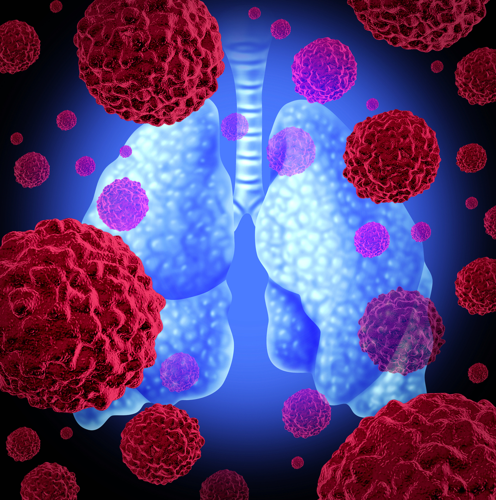 Therapy for Advanced NonSmall Cell Lung Cancer Showing